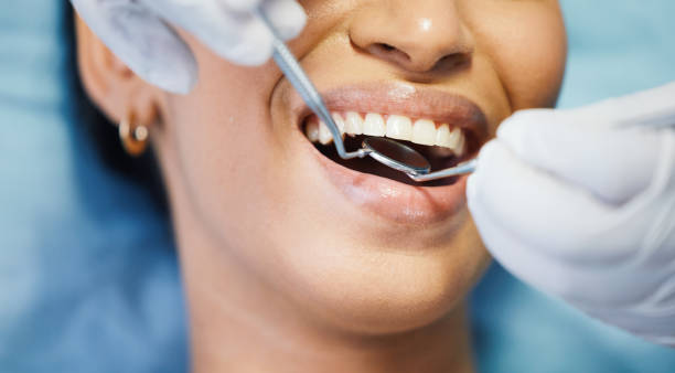 Best Emergency Tooth Extraction in Cimarron Hills, CO